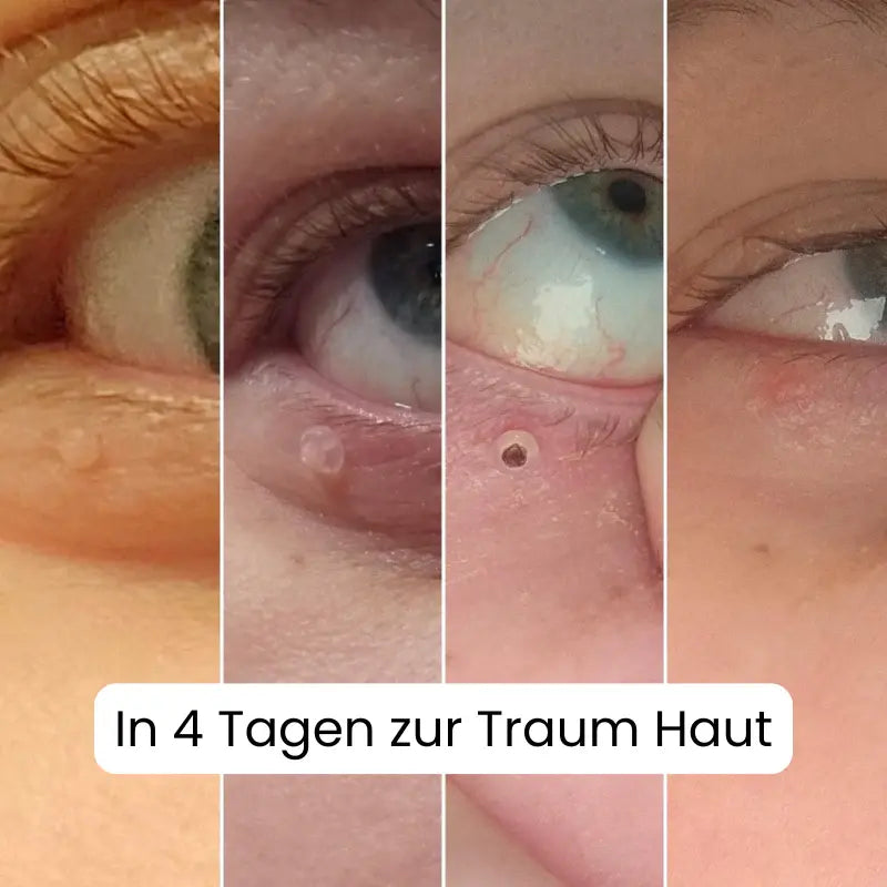 HEVILUXY™ Komplett-Set – Für Hautanhängsel-Bedürfnisse